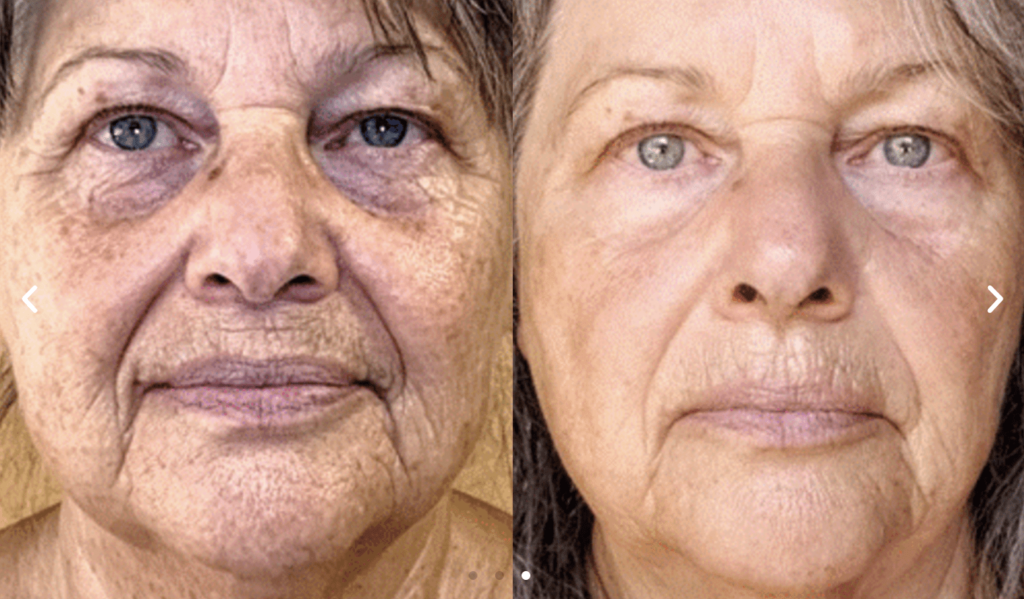 ADVATx-Laser-Before-and-After(1)