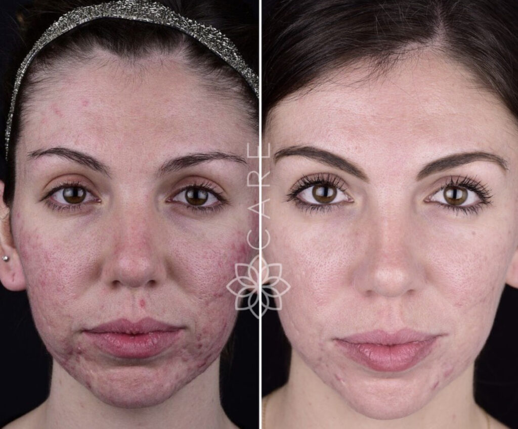 PRF-Microneedling-for-Acne-Scaring-Results